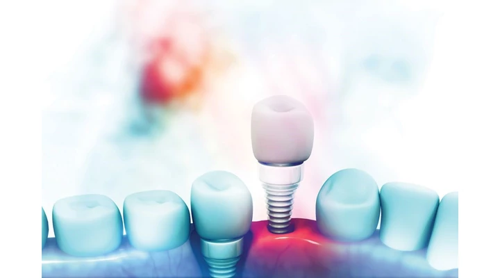 A fogászati implantátum a szakma jövőjének új alapja